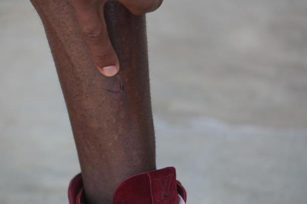 FOTO: Zé Roberto mostra machucado na canela atingida por Vanderlei